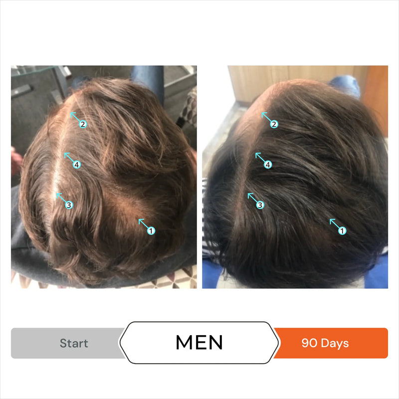 Revita Conditioner before after men 2 with points of regrowth